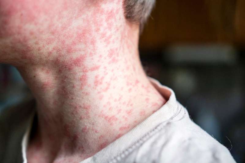 Pennsylvania's 6th measles death reported in Franklin County